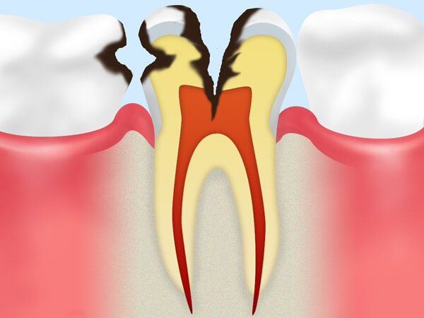 C3：歯の神経に達した虫歯